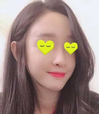 Mình đã thực hiện cấy mỡ toàn mặt bởi Viện trưởng Kim Jun-hyun!