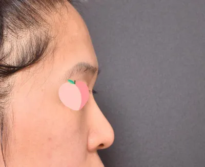 Mình đã phẫu thuật nâng mũi với bác sĩ Lim Young-min tại Bệnh viện thẩm mỹ Very Good.