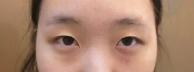 Mình đã thực hiện với Viện trưởng Kim Jun-hyeon tại Bệnh viện thẩm mỹ Very Good.