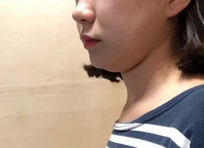 Hút mỡ nọng cằm đúng là một thế giới mới đối với mình..bb