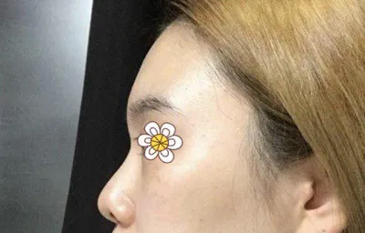 Phẫu thuật lại mũi của mình đẹp quá!!!!