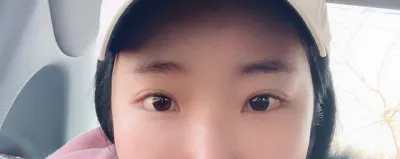 Mình đã phẫu thuật lại hạ đuôi mắt rồi hihi.