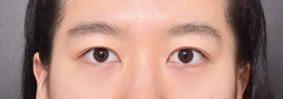 Ca phẫu thuật lại mắt của mình thành công rồi ㅠㅠ