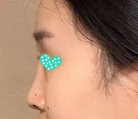 Đã 63 ngày trôi qua kể từ khi mình phẫu thuật mũi rồi.