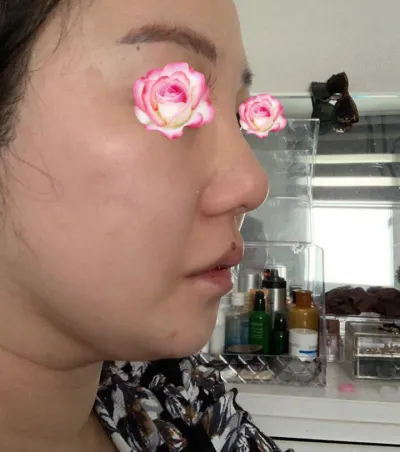 Mình đã phẫu thuật nâng mũi tại Bệnh viện thẩm mỹ Very Good.