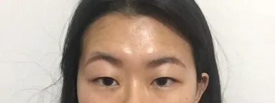 Mình đã thực hiện căng da trán và chỉnh hình mắt bằng phương pháp nhấn mí với Viện trưởng Kim Jun-hyun tại Thẩm mỹ viện Very Good.