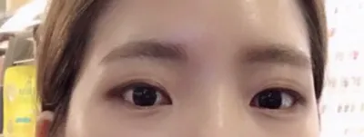 Đây là review sau khoảng 5~6 tuần mình cắt mí kkk