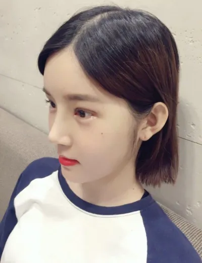 Mình phẫu thuật gò má được 2 tuần rồi!!