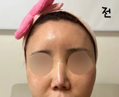 Review phẫu thuật lại mũi ngắn của mình