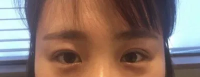 Review của mình sau 12 ngày phẫu thuật thẩm mỹ mắt~