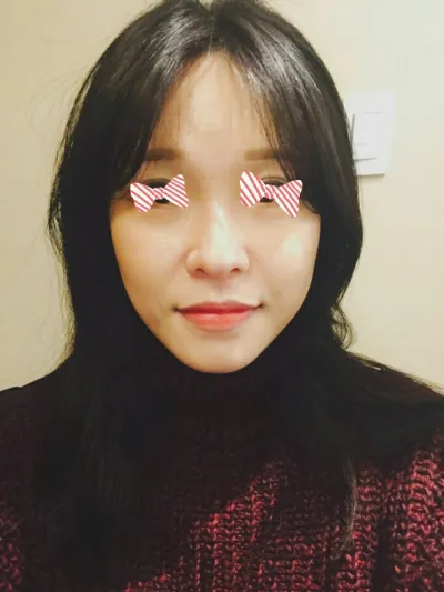 Cấy mỡ mặt tự thân!