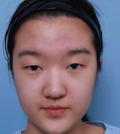 Mắt mình được 7 ngày rồi.