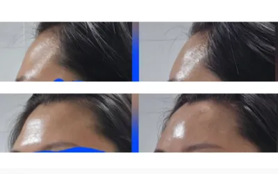 [Khách hàng Ch**] Đánh giá sau khi tiêm filler trán