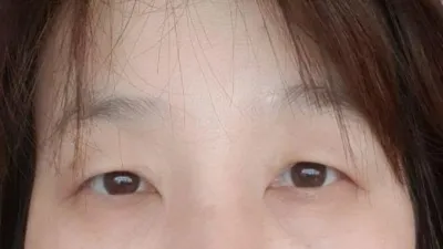 Review phẫu thuật mắt của mình