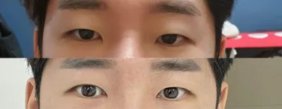 Review phẫu thuật mắt của mình