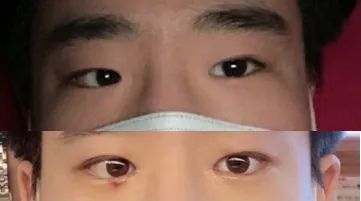 Review phẫu thuật mắt của mình