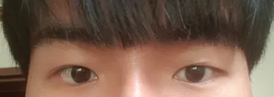 Review phẫu thuật lại mắt của mình