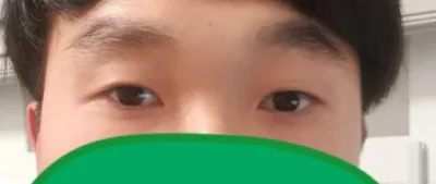 Review phẫu thuật mắt của mình