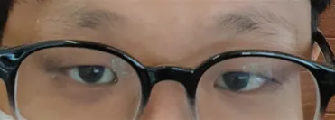 Review phẫu thuật mắt của mình