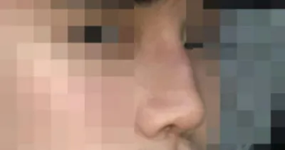 Review phẫu thuật mũi của mình