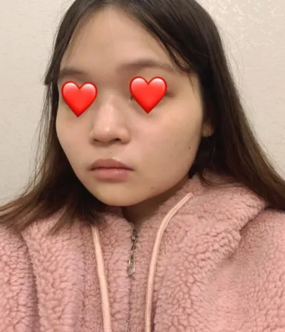 Review phẫu thuật mũi | tạo hình khuôn mặt của mình