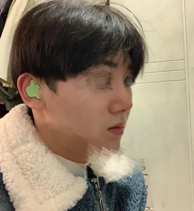 Review phẫu thuật lại mũi của mình