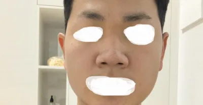 Review phẫu thuật mũi của mình