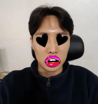 Phẫu thuật lại mũi | Review nâng cơ của mình