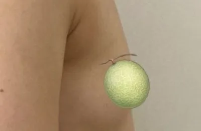 Một tháng nâng ngực Motiva của mình