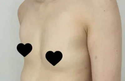 Đây là review phẫu thuật ngực của mình.