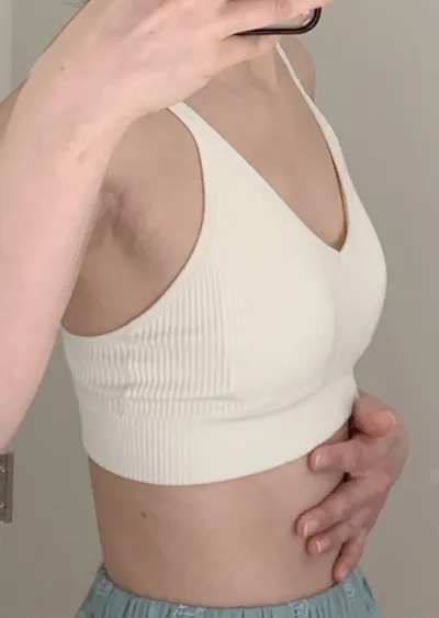 Review nâng ngực sau 2 tháng của mình (Motiva/ 355cc/ Đường chân ngực)