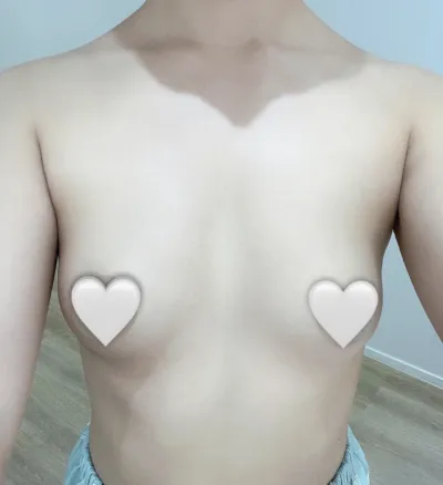 Mentor Xtra + Loại bỏ ngực phụ) Review 1 tháng cực kỳ hài lòng của mình.