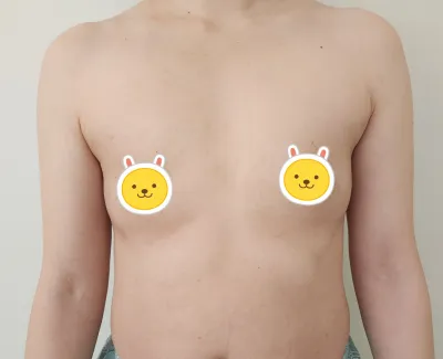 [Tái phẫu thuật] Ngực Melon tuần thứ 1 của mình!