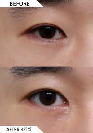 Before