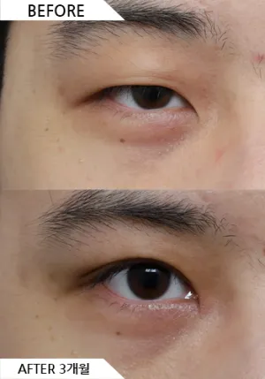 Before
