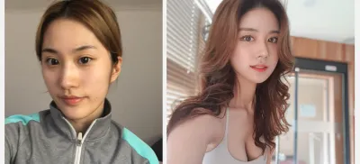 Mắt, mũi, gọt mặt, cấy mỡ toàn mặt, tiêm filler môi