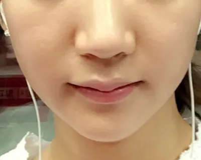 Thermage đúng là công nghệ đỉnh cao