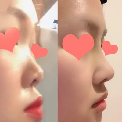 Review sau phẫu thuật nâng mũi!!