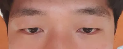 Phẫu thuật cắt mí mắt