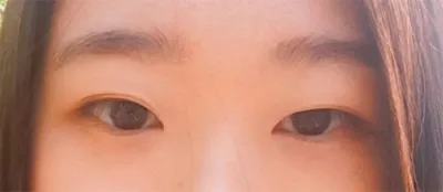 Đánh giá phẫu thuật mắt hai mí không cắt!