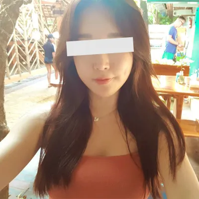 ★Đánh giá sau 1 năm rưỡi phẫu thuật thu nhỏ gò má★