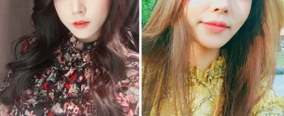 Tiêm filler khóe môi