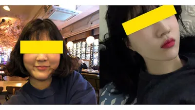 Gọt mặt - Mình đã phẫu thuật thu nhỏ xương gò má!