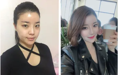 Mình đã thực hiện 4 loại phẫu thuật thẩm mỹ khuôn mặt tại Jayjun ~