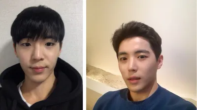 Mình đã phẫu thuật chỉnh sửa mắt, mở góc mắt và phẫu thuật mũi.