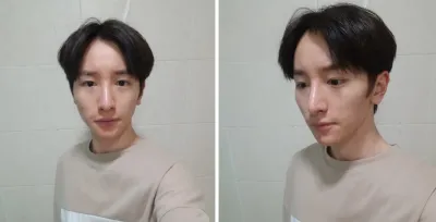 Gọt mặt, Nâng mũi, Cấy mỡ toàn mặt