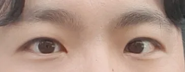 Mình đã thực hiện phẫu thuật chỉnh sửa mí mắt cho nam (bao gồm mở góc mắt trong, rạch da)~~!!