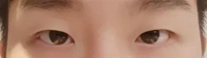 Đánh giá sau 10 ngày phẫu thuật mắt nam (chỉnh sửa mí mắt (không cắt), mở góc mắt trước)