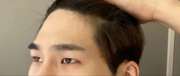 Đánh giá sau 5 tháng thực hiện phẫu thuật chỉnh sửa mí mắt và nâng trán!