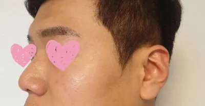 Sống mũi, đầu mũi, chỉnh sửa mũi to, mũi гор